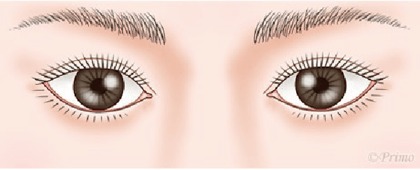 二重修正術 後の目元イラスト